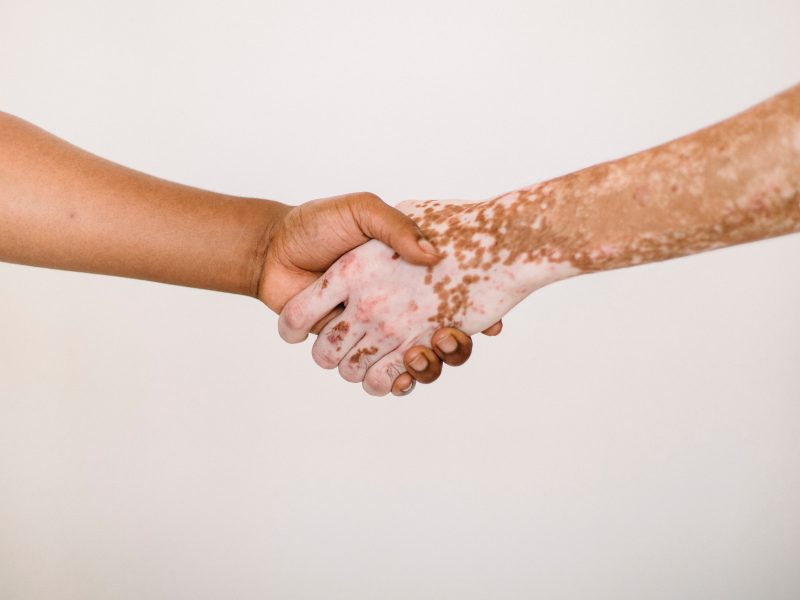 poignee de mains vitiligo